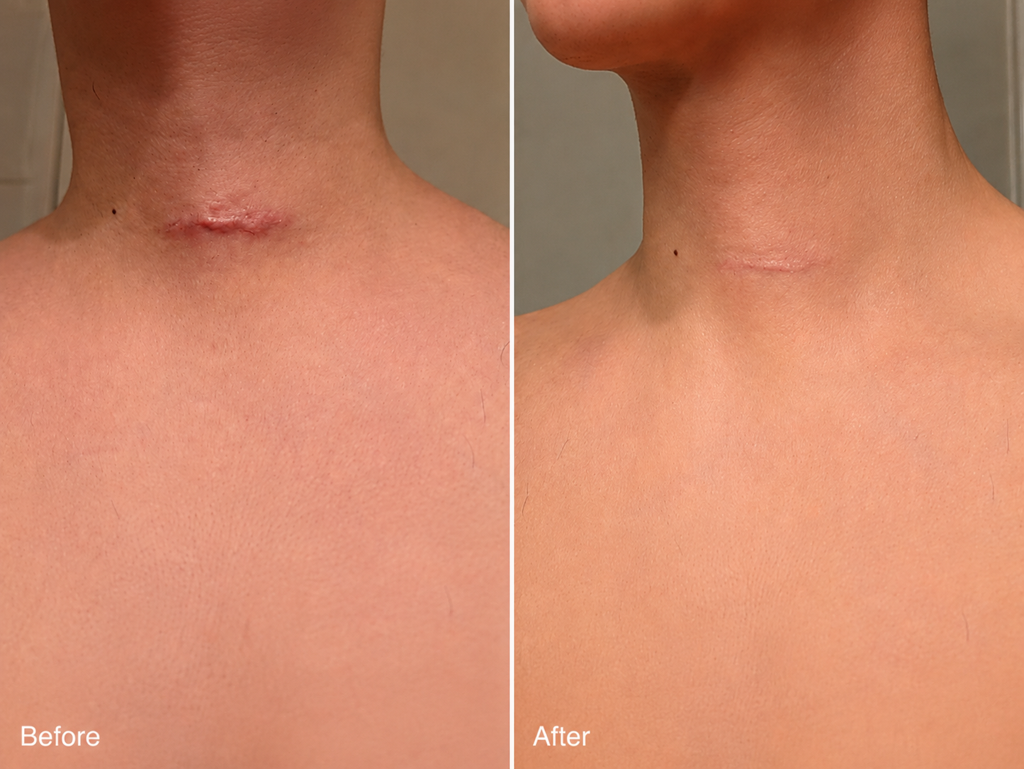 Celsiora® 2-in-1 Microneedle & Hydrocolloid Patch