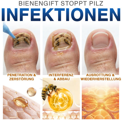 up✅ Fungi Free Bienengift Nagelpilz Behandlung – Intensive Pflege für gesünder aussehende Nägel💅