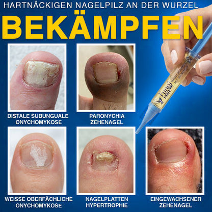 up✅ Fungi Free Bienengift Nagelpilz Behandlung – Intensive Pflege für gesünder aussehende Nägel💅