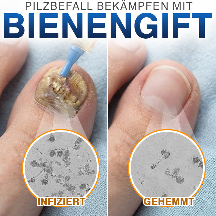 up✅ Fungi Free Bienengift Nagelpilz Behandlung – Intensive Pflege für gesünder aussehende Nägel💅