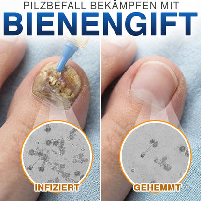 up✅ Fungi Free Bienengift Nagelpilz Behandlung – Intensive Pflege für gesünder aussehende Nägel💅