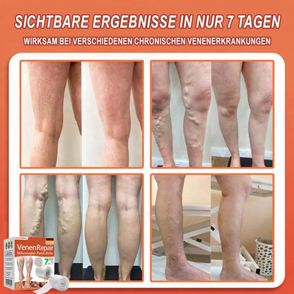 Celsiora® Vein Ease Microneedle-Pflegepflaster – Bei Besenreisern, Krampfadern, Schwellungen & müden Beinen | Nur heute 50 % Rabatt