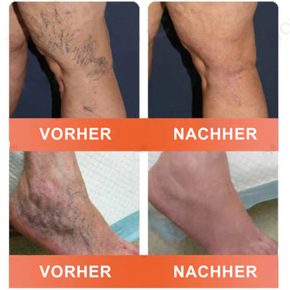 Celsiora® Vein Ease Microneedle-Pflegepflaster – Bei Besenreisern, Krampfadern, Schwellungen & müden Beinen | Nur heute 50 % Rabatt