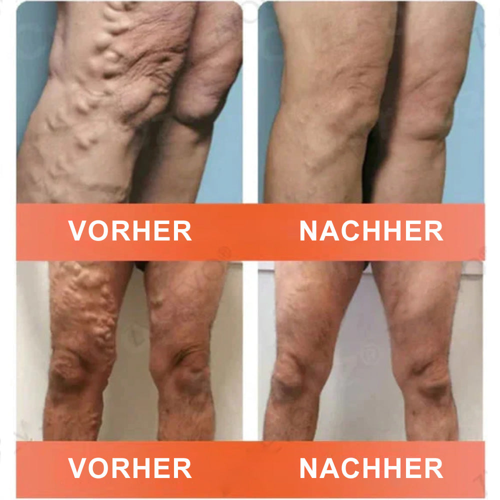 Celsiora® Vein Ease Microneedle-Pflegepflaster – Bei Besenreisern, Krampfadern, Schwellungen & müden Beinen | Nur heute 50 % Rabatt