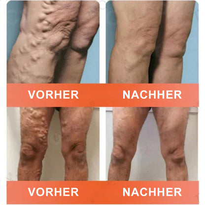 Celsiora® Vein Ease Microneedle-Pflegepflaster – Bei Besenreisern, Krampfadern, Schwellungen & müden Beinen | Nur heute 50 % Rabatt